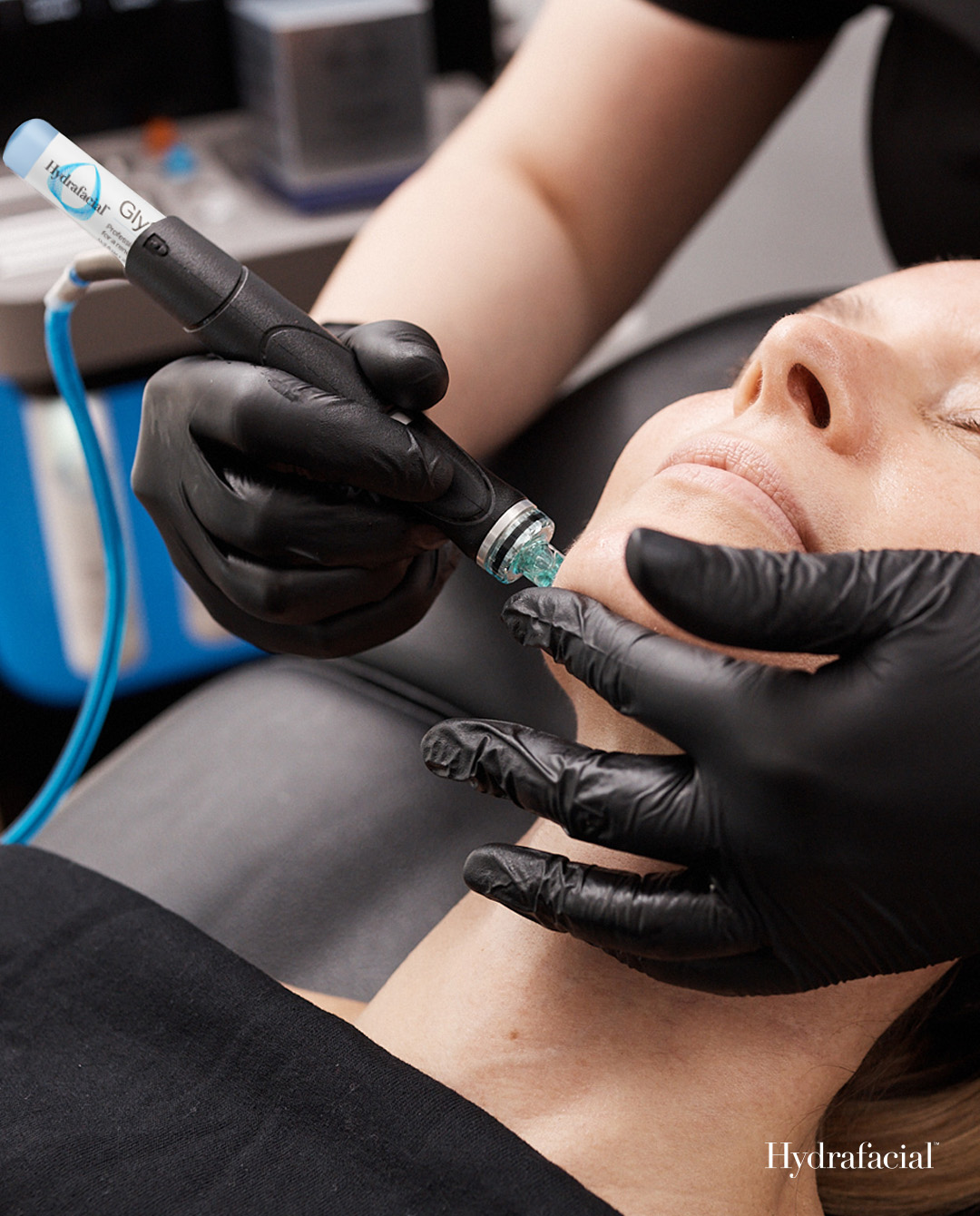A Hydrafacial treatment being performed on a client's face at Lunar Bloom Esthetics in Granger, Indiana